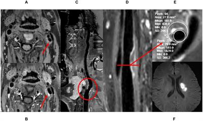 Differences in Wall Shear Stress Between High-Risk and Low-Risk Plaques in Patients With Moderate Carotid Artery Stenosis: A 4D Flow MRI Study